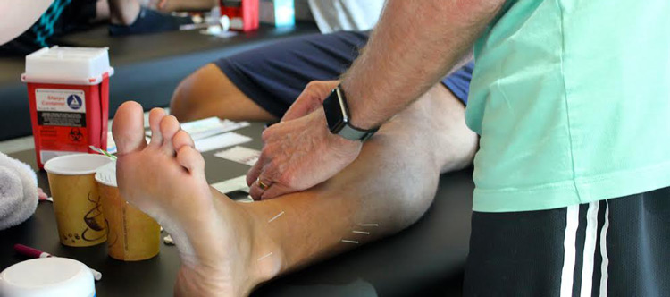 Six Facts About Dry Needling