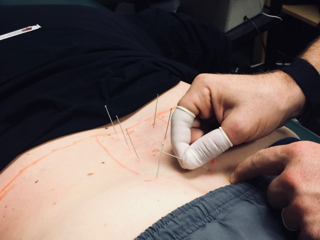 Learn Advanced Dry Needling Concepts LPH in Tempe, AZ starting March 27, 2021