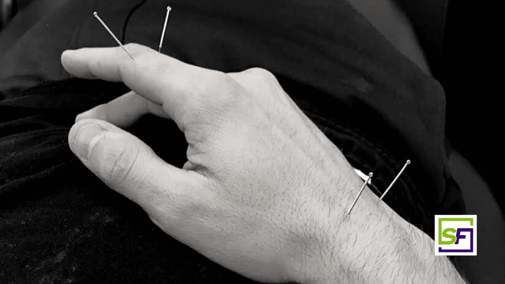 man's hand having accupuncture
