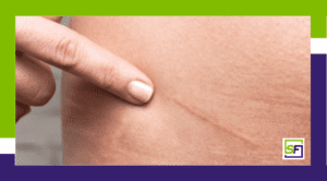 Dry Needling for the Treatment of Scars