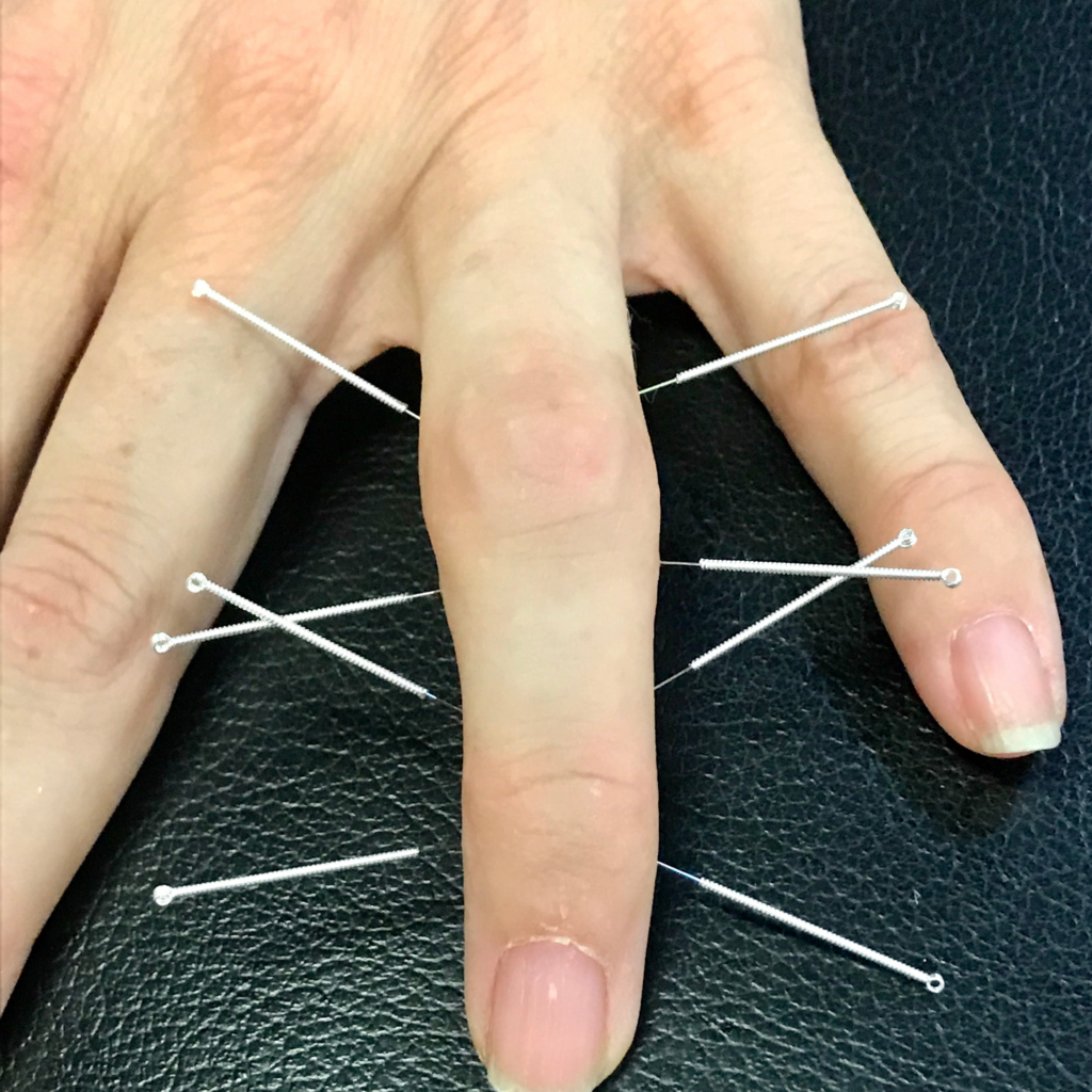 best dry needling courses for physical therapists